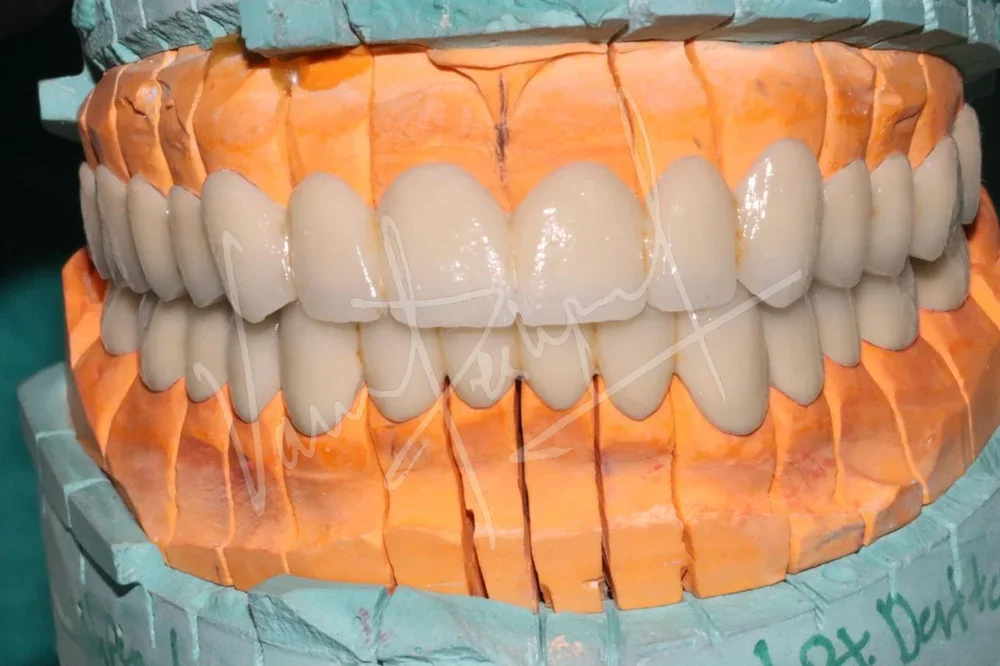 FMR with Porcelain-Fused-to-Metal Prosthesis DB - Image 1