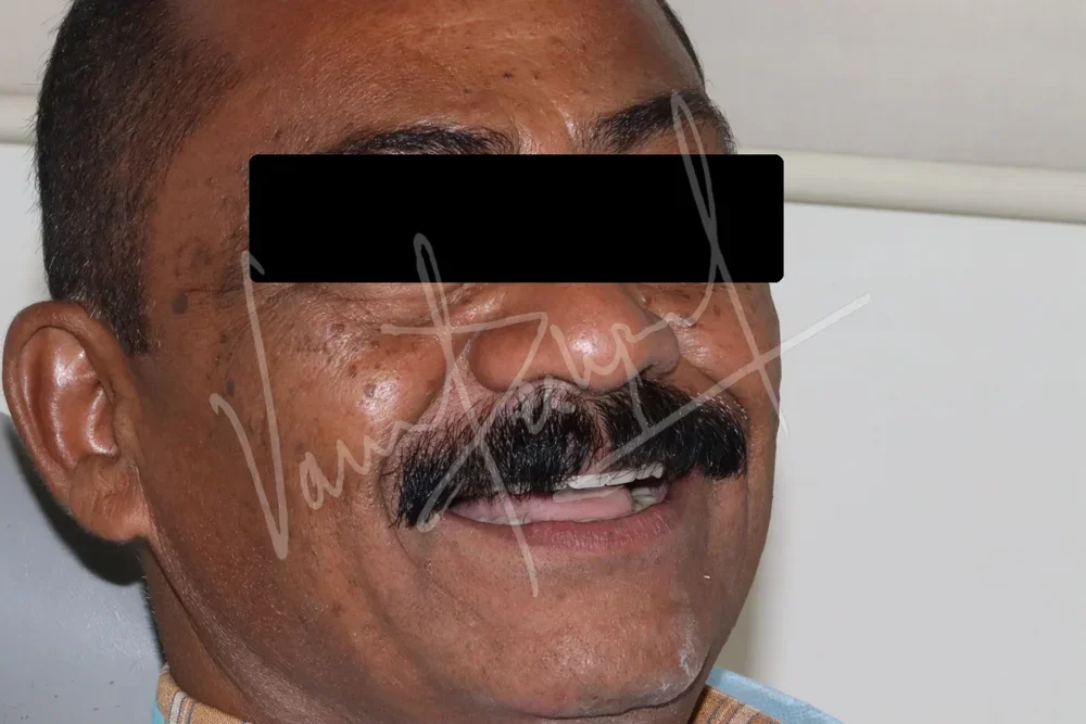 FMR with Porcelain-Fused-to-Metal Prosthesis DB - Image 3