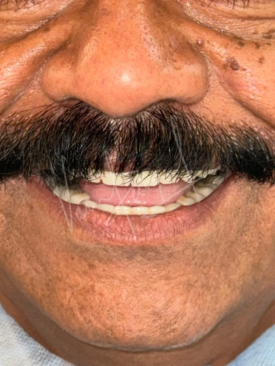 FMR with Porcelain-Fused-to-Metal Prosthesis DB - Image 4