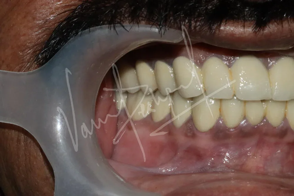 FMR with Porcelain-Fused-to-Metal Prosthesis DB - Image 6