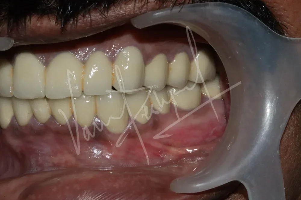 FMR with Porcelain-Fused-to-Metal Prosthesis DB - Image 7