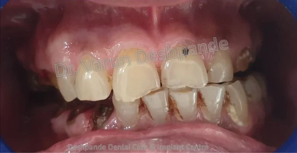 FMR with Porcelain-Fused-to-Metal Prosthesis RR - Image 1