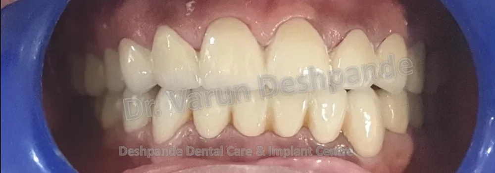 FMR with Porcelain-Fused-to-Metal Prosthesis RR - Image 2