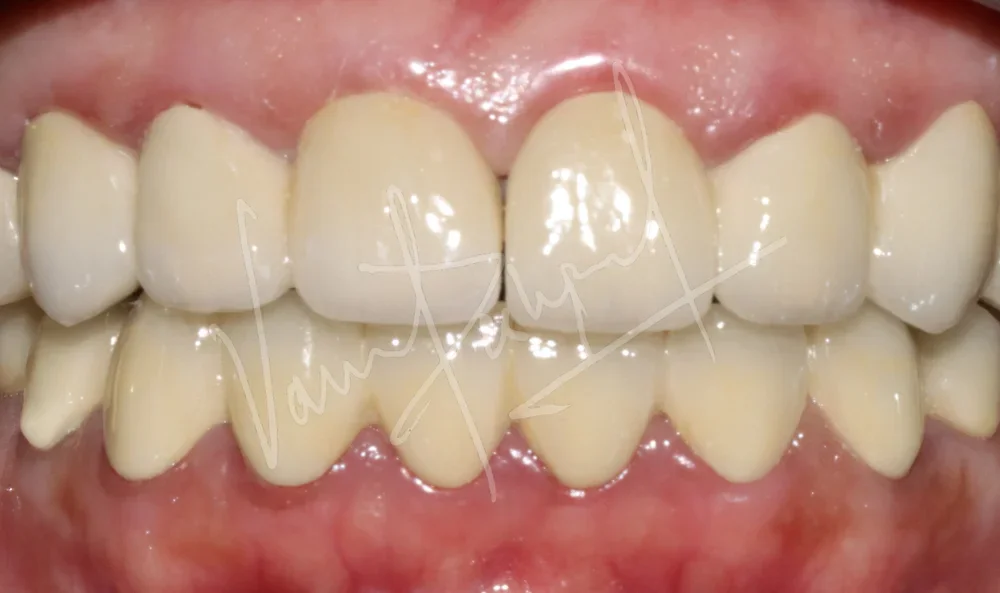 FMR with Porcelain-Fused-to-Metal Prosthesis VA - Image 1
