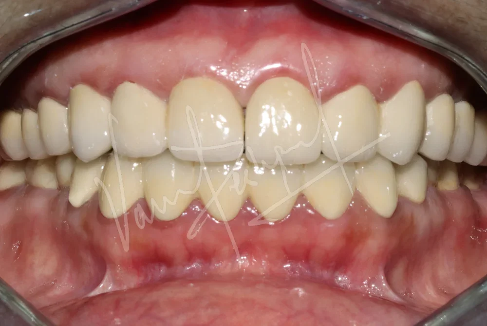 FMR with Porcelain-Fused-to-Metal Prosthesis VA - Image 2