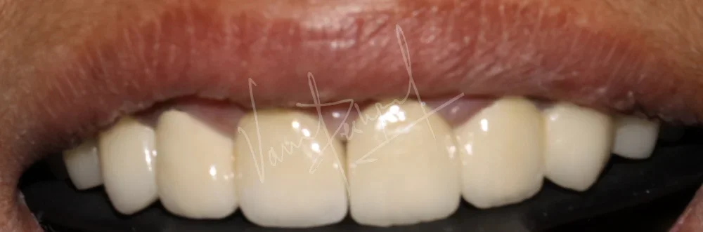 FMR with Porcelain-Fused-to-Metal Prosthesis VA - Image 3