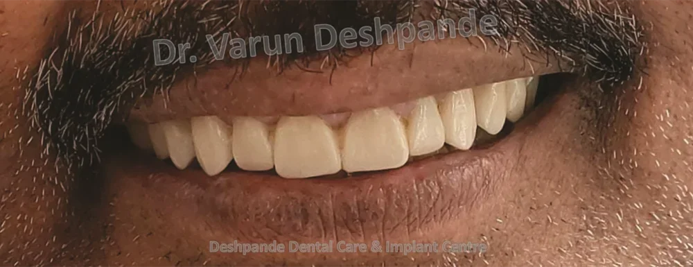 Full Mouth Rehabilitation using All Ceramic Prosthesis - Image 2