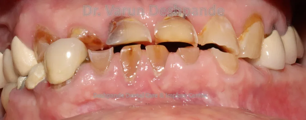 Full Mouth Rehabilitation using Dental Implants and Crown and Bridge - Image 1