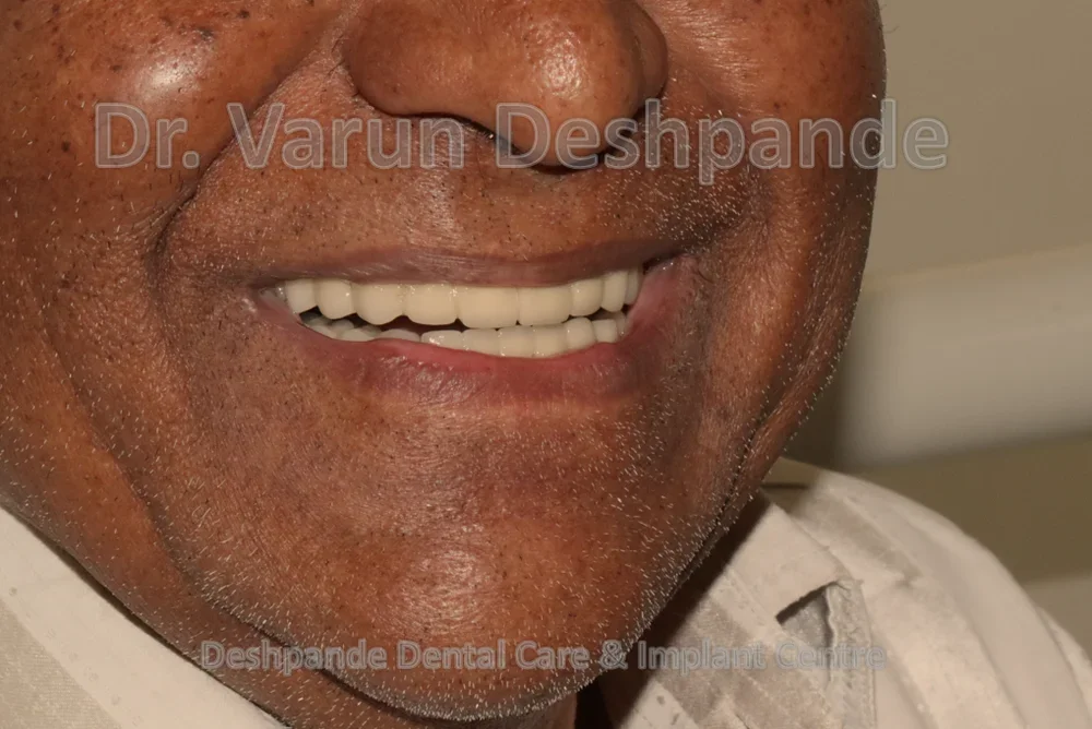 Full Mouth Rehabilitation using Dental Implants and Crown and Bridge - Image 12