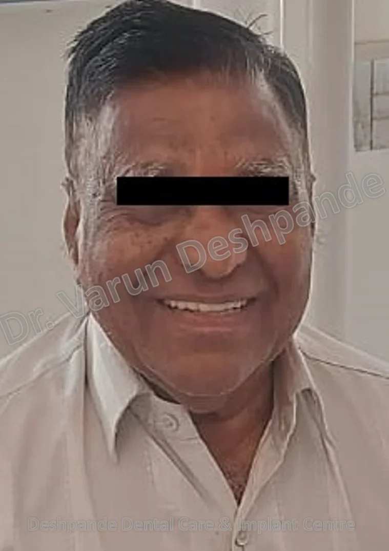 Full Mouth Rehabilitation using Dental Implants and Crown and Bridge - Image 13