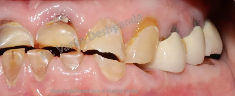 Full Mouth Rehabilitation using Dental Implants and Crown and Bridge - Image 3
