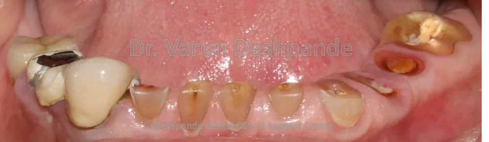 Full Mouth Rehabilitation using Dental Implants and Crown and Bridge - Image 4