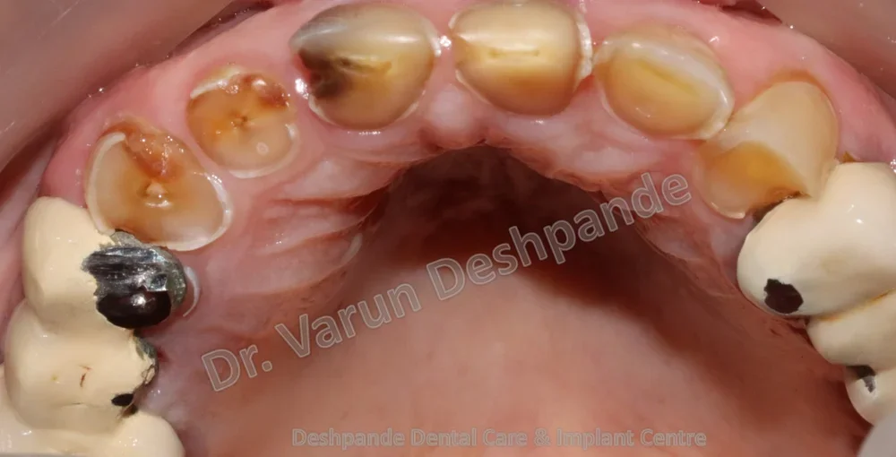 Full Mouth Rehabilitation using Dental Implants and Crown and Bridge - Image 5