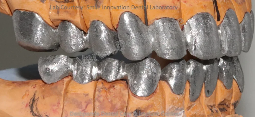 Full Mouth Rehabilitation using Dental Implants and Crown and Bridge - Image 7