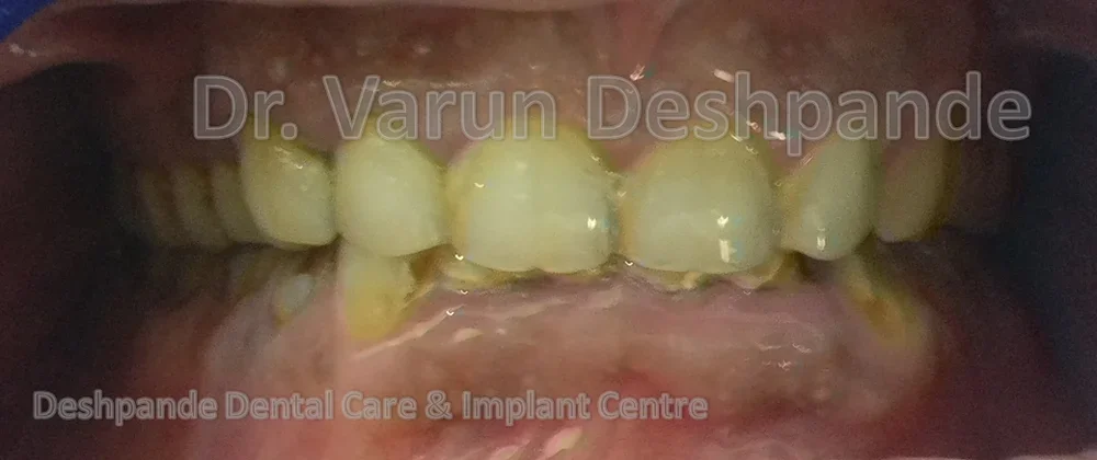 Full Mouth Rehabilitation using Metal Ceramic Prosthesis - Image 1