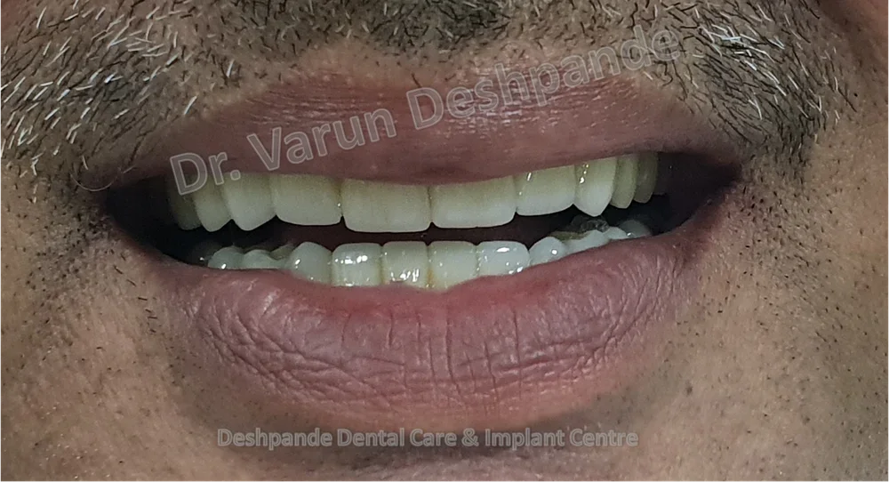 Full Mouth Rehabilitation using Metal Ceramic Prosthesis - Image 3