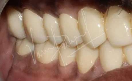 Full Mouth Rehabilitation using Zirconia Monolithic Prosthesis - Image 13
