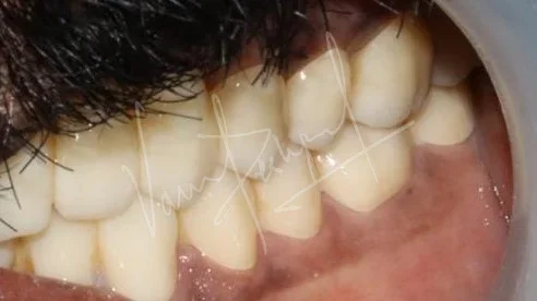 Full Mouth Rehabilitation using Zirconia Monolithic Prosthesis - Image 14