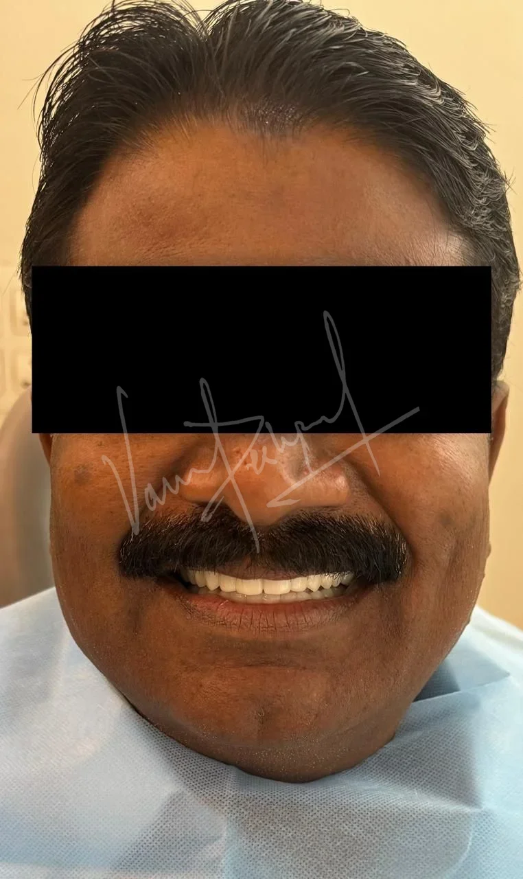 Full Mouth Rehabilitation using Zirconia Monolithic Prosthesis - Image 15