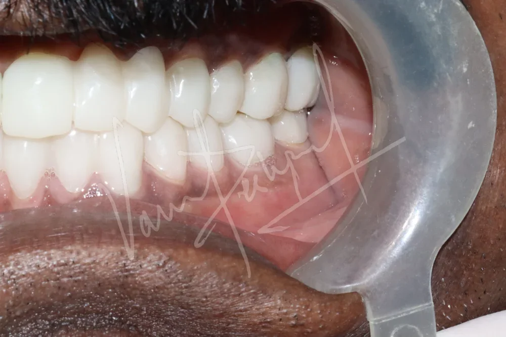 Full Mouth Rehabilitation using Zirconia Monolithic Prosthesis - Image 3