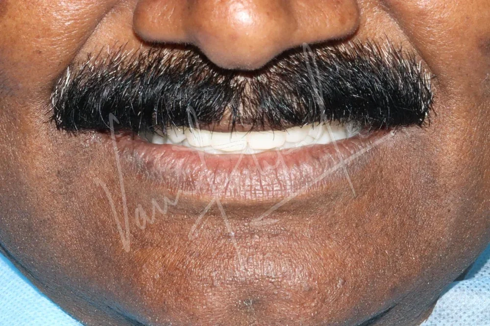 Full Mouth Rehabilitation using Zirconia Monolithic Prosthesis - Image 4