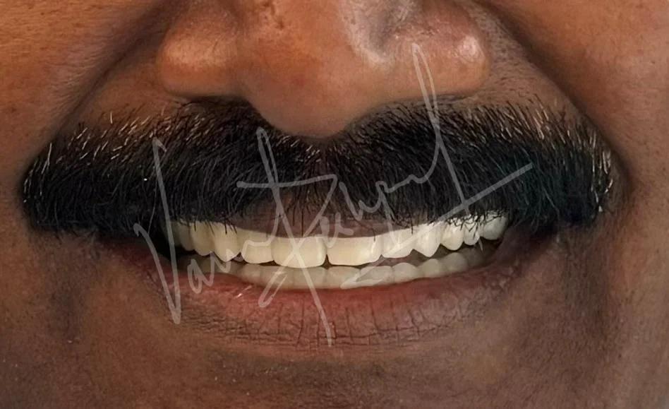 Full Mouth Rehabilitation using Zirconia Monolithic Prosthesis - Image 5