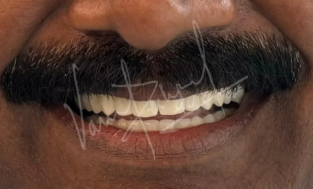 Full Mouth Rehabilitation using Zirconia Monolithic Prosthesis - Image 6