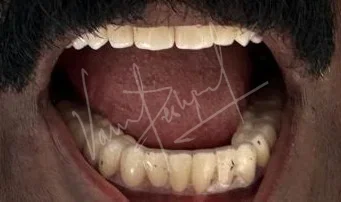 Full Mouth Rehabilitation using Zirconia Monolithic Prosthesis - Image 8