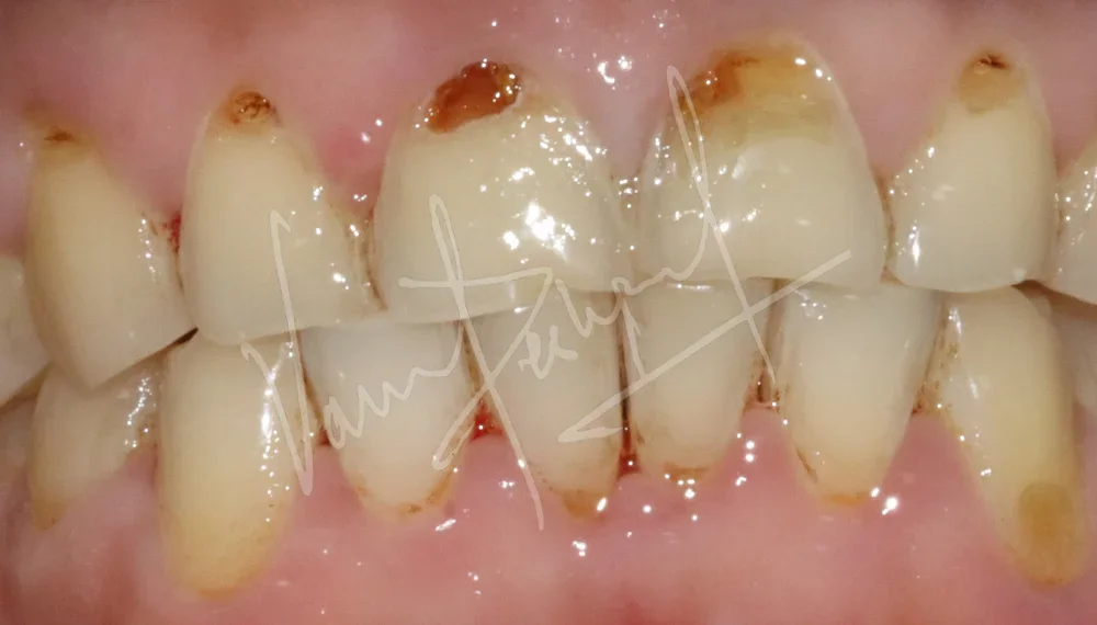 Full Mouth Rehabilitation using Zirconia Prosthesis - Image 1