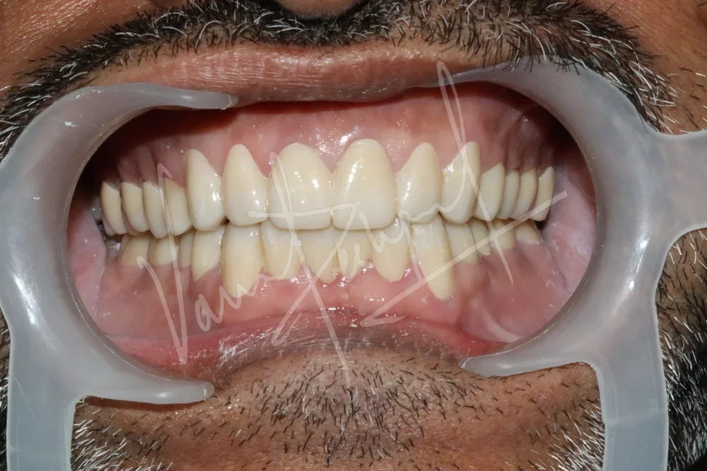Full Mouth Rehabilitation using Zirconia Prosthesis - Image 10