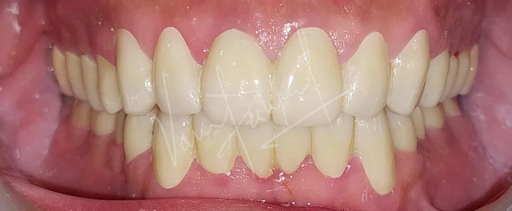 Full Mouth Rehabilitation using Zirconia Prosthesis - Image 11