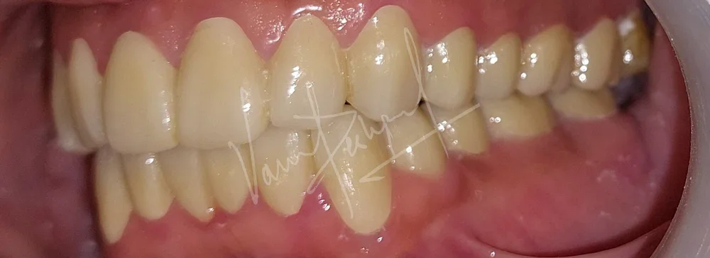 Full Mouth Rehabilitation using Zirconia Prosthesis - Image 13