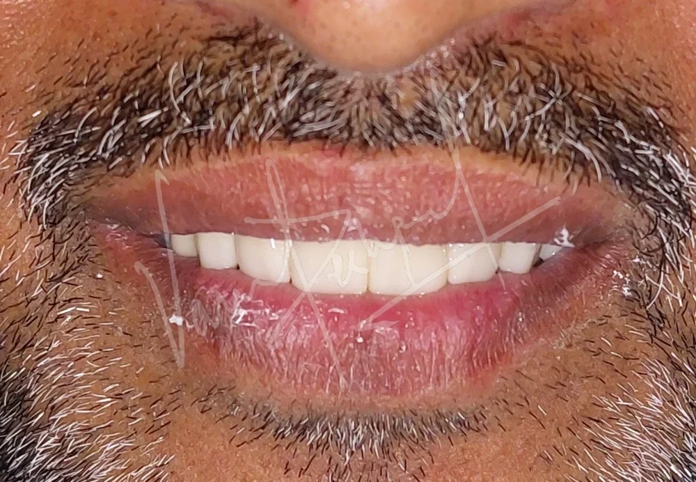 Full Mouth Rehabilitation using Zirconia Prosthesis - Image 14