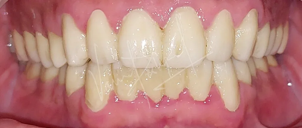 Full Mouth Rehabilitation using Zirconia Prosthesis - Image 15