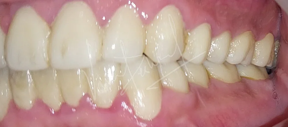 Full Mouth Rehabilitation using Zirconia Prosthesis - Image 17