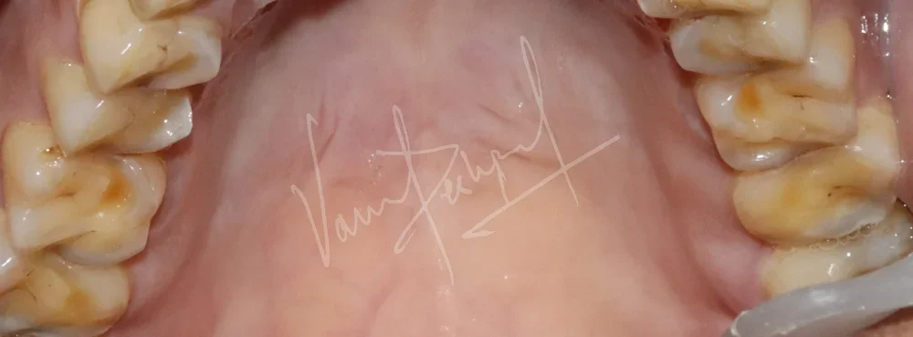 Full Mouth Rehabilitation using Zirconia Prosthesis - Image 2