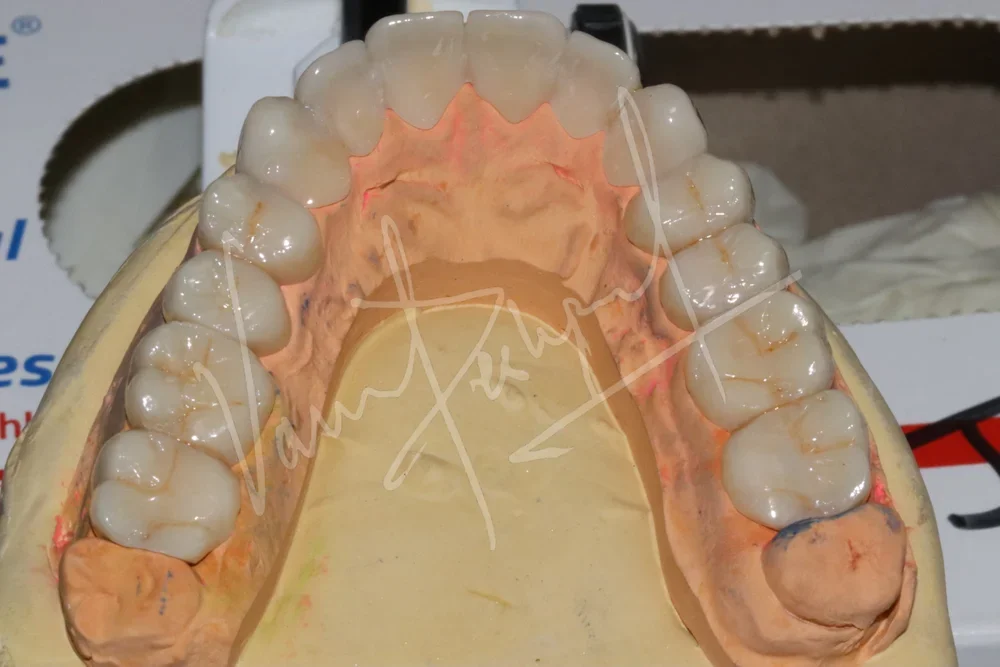 Full Mouth Rehabilitation using Zirconia Prosthesis - Image 4