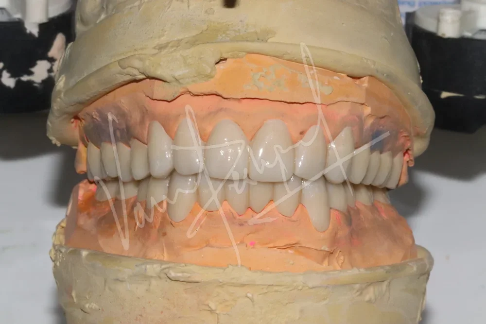 Full Mouth Rehabilitation using Zirconia Prosthesis - Image 7