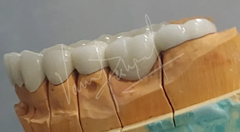 Full Mouth Rehabilitation with Metal Ceramic Prosthesis - Image 1
