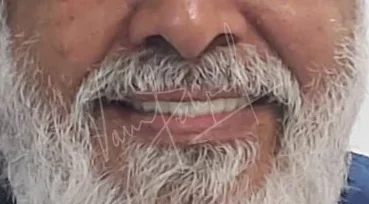 Full Mouth Rehabilitation with Metal Ceramic Prosthesis - Image 10