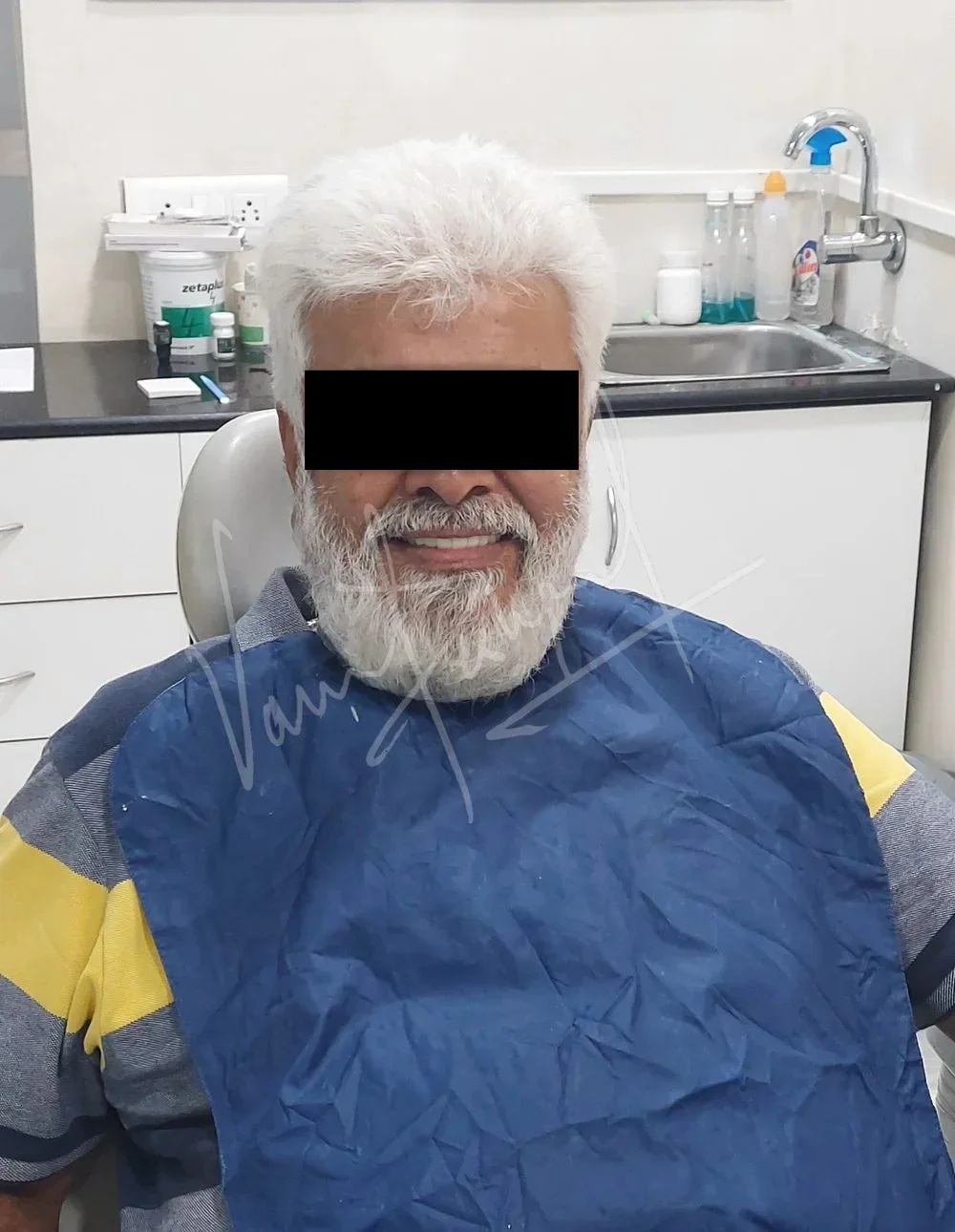 Full Mouth Rehabilitation with Metal Ceramic Prosthesis - Image 11