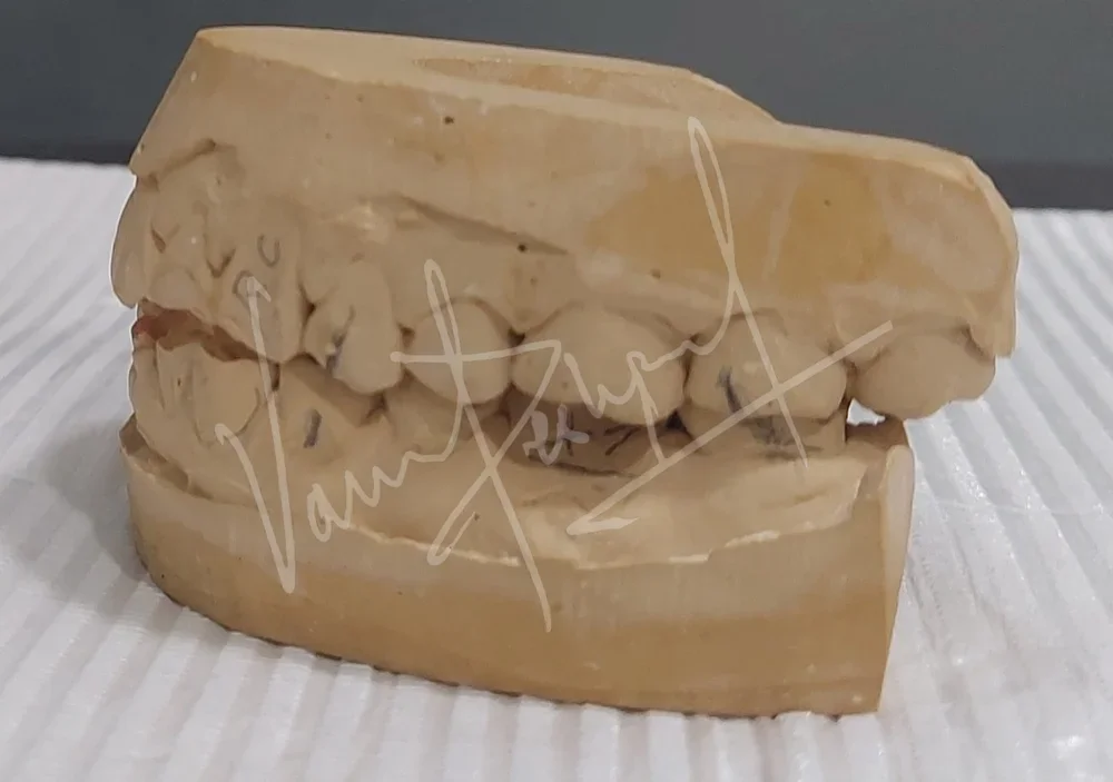 Full Mouth Rehabilitation with Metal Ceramic Prosthesis - Image 4