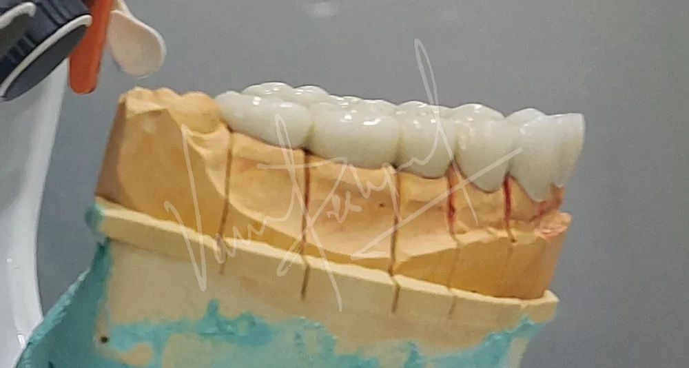Full Mouth Rehabilitation with Metal Ceramic Prosthesis - Image 9