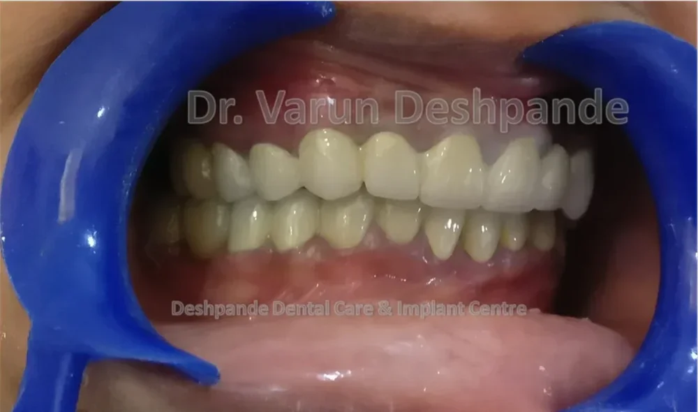 Full Mouth Rehabilitation with Metal Ceramic Prosthesis JU - Image 1