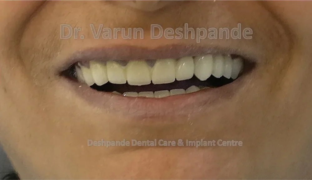 Full Mouth Rehabilitation with Metal Ceramic Prosthesis JU - Image 2