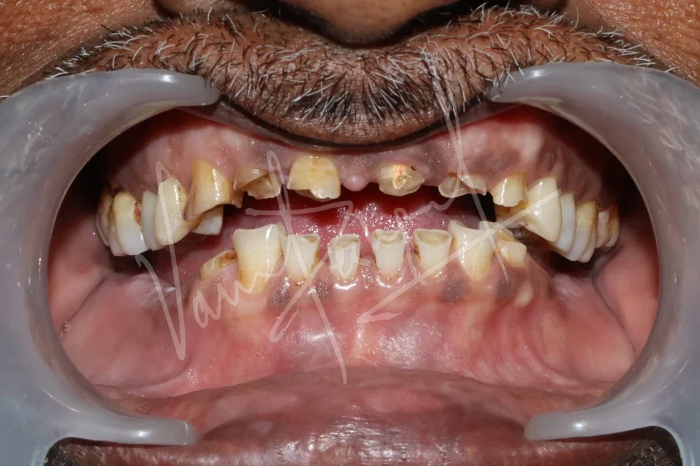 Full Mouth Rehabilitation with Metal Ceramic Restoration and Dental Implants - Image 2