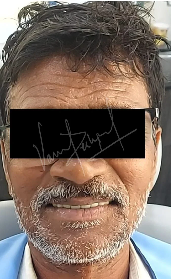 Full Mouth Rehabilitation with Metal Ceramic Restoration and Dental Implants - Image 5