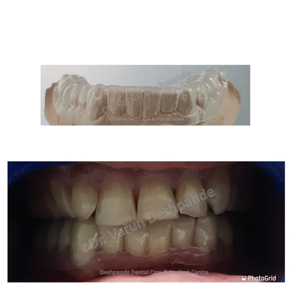 Lower Arch Reconstruction with Zirconia Prosthesis - Image 10