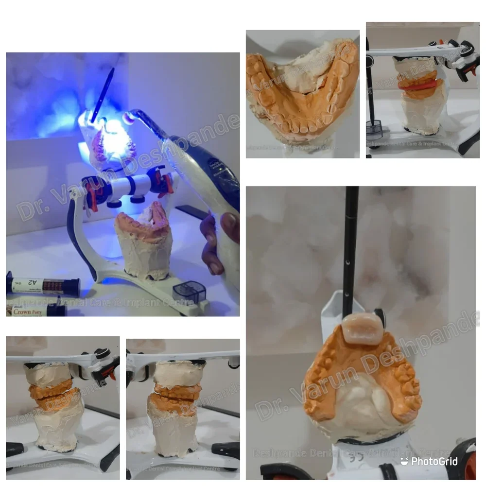 Lower Arch Reconstruction with Zirconia Prosthesis - Image 3