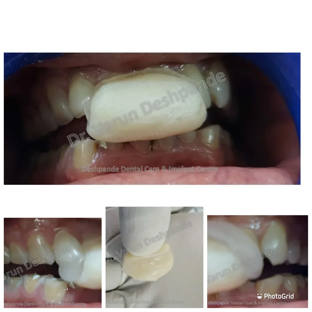 Lower Arch Reconstruction with Zirconia Prosthesis - Image 4